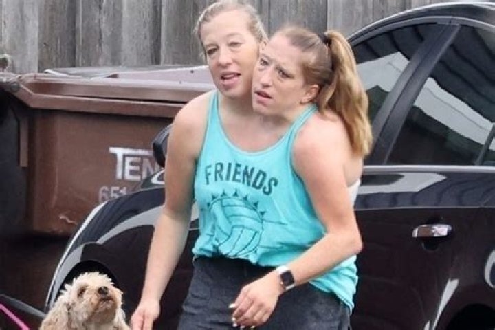 Are The Unfortunate Hensel Twins Still Alive?