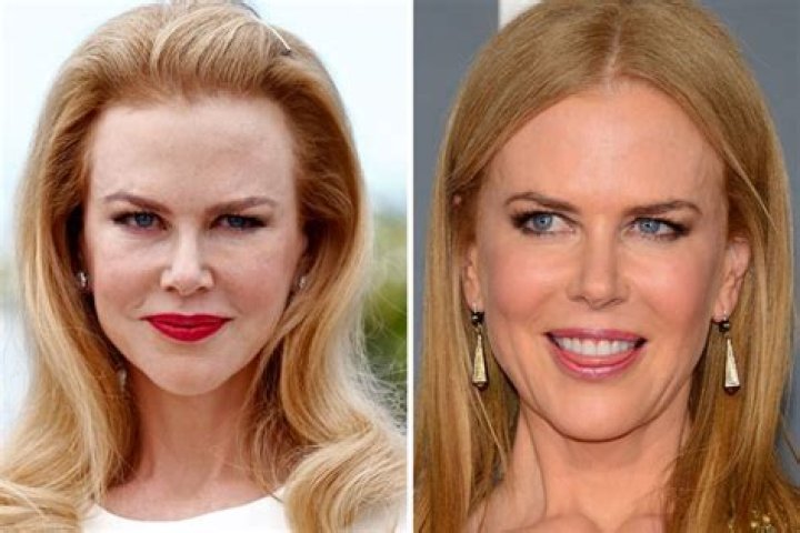 The Truth About Botox: Nicole Kidman's Experience