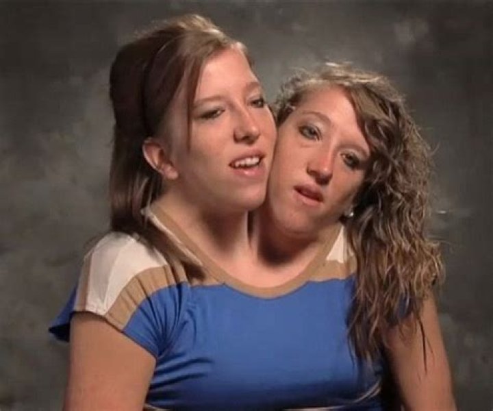 Extraordinary TLC Conjoined Twins: A Miraculous Story