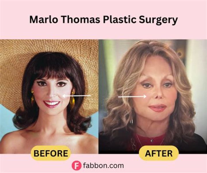 Marlo Thomas Nose Job: Truth Unveiled