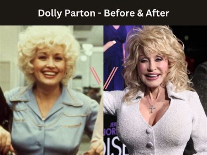 Dolly Parton's Implants: An Inside Look At Her Iconic Enhancements