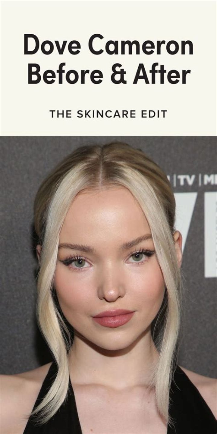 Dove Cameron's Natural Beauty: Before And After Lip Fillers