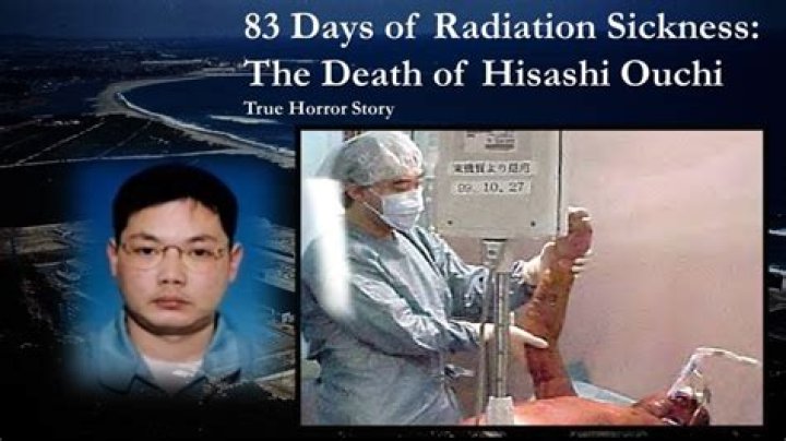 Hisashi Ouchi's Skin: A Devastating Nuclear Accident's Progression