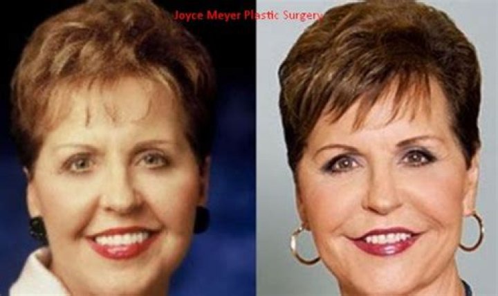 Joyce Meyer's Face Surgery: Transformation Unveiled