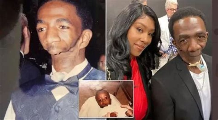 The Extraordinary Life Of The Man Without A Jaw: A Testament To Resilience