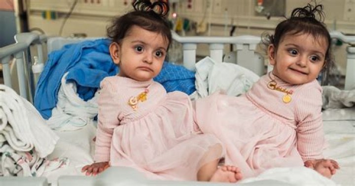 The Extraordinary Story Of Mia And Lia: Conjoined Twins Who Defy All Odds