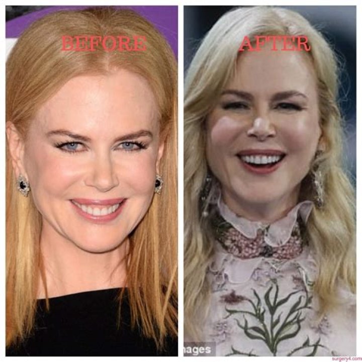 The Truth About Nicole Kidman's Plastic Surgery: A Comprehensive Guide