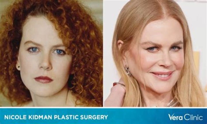 Unveiling Nicole Kidman's Plastic Surgery: Before And After