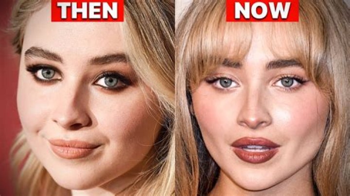 The Ultimate Guide To Sabrina Carpenter's Filler: Benefits, Risks, And Results
