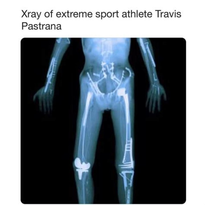 Unveiling The Impact Of Travis Pastrana's Injuries: Discoveries And Insights